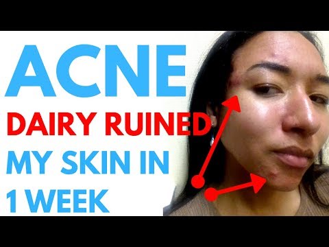 ACNE BREAKOUT AND DAIRY (HERE&#;S WHAT HAPPENED)