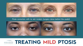 How Mild Ptosis is Treated