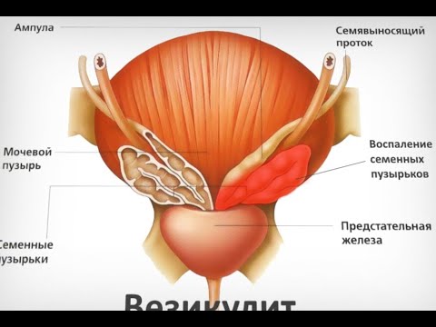 Везикулит