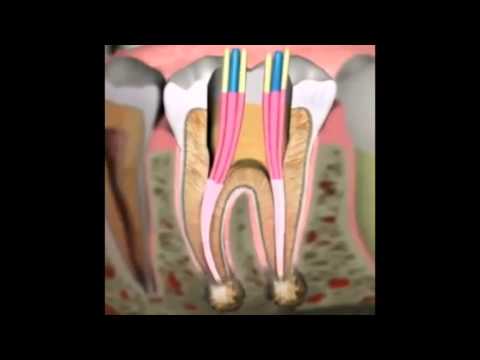 kanal tedavisi nasıl yapılır. Diş hekimi Hamza Keskin