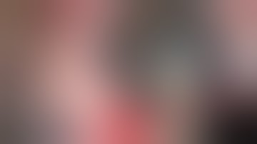 Cataract Surgery Soft Nucleus SICS