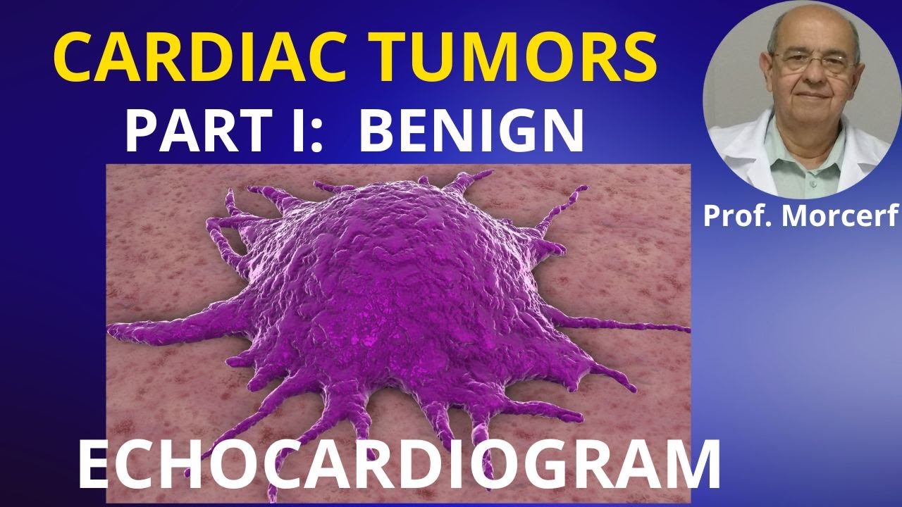 Benign Cardiac Tumors (Tips and Pitfalls):  Part 1. 