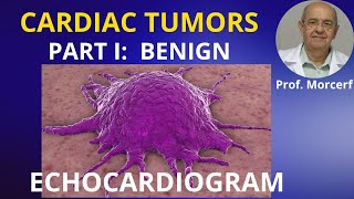 Benign Cardiac Tumors Tips and Pitfalls Part 1 echocardiography