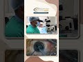 Live Cataract Surgery in Just 5 Minutes | Step-by-Step Procedure | Netravedam Eye Hospital ✨👁️