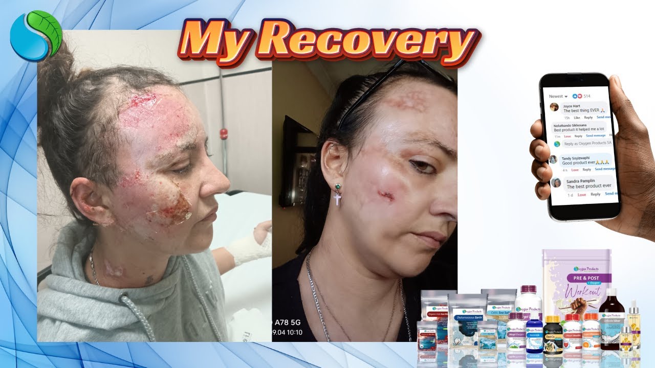 How I Healed from a Cooking Oil Burn and Seizure with Oxygen Products
