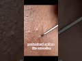 Black Heads Removal
