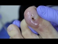 Ep_619 Ingrown nail removal 👣 น้องเป็นเล็บขบมา 2 ปี ถูกนิดเลือดออก (This video clip from thailand)