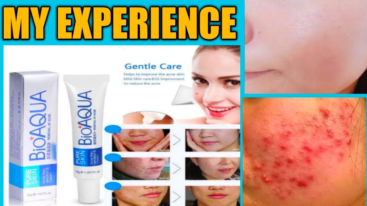 review bioaqua removal of acne