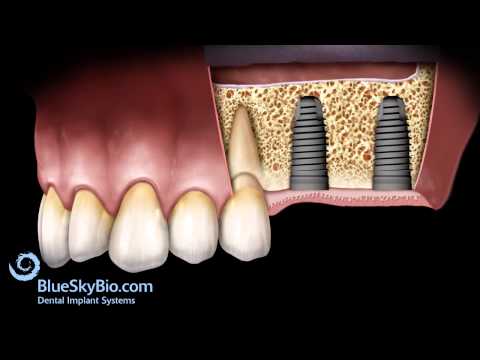 Patient Treatment Videos: Sinus Lift Lateral