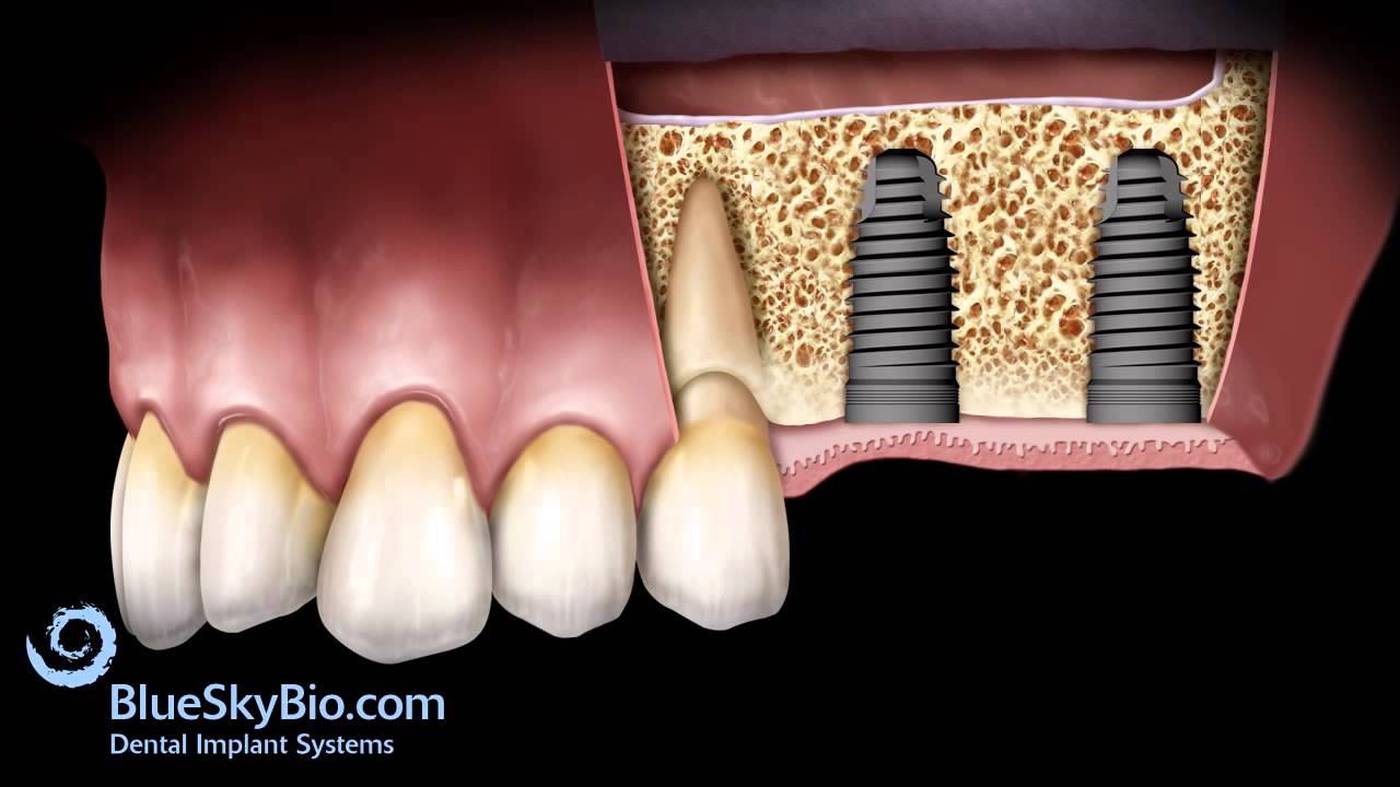Patient Treatment Videos Sinus Lift Lateral YouTube