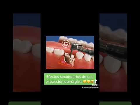 Video: ¿Son peligrosos los dientes rotos?