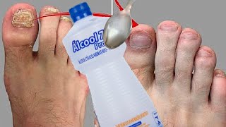 Como Tratar Micose nas Unhas com Cravo da Índia e Álcool 70%