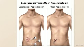 Appendix surgery (laparoscopic vs open)