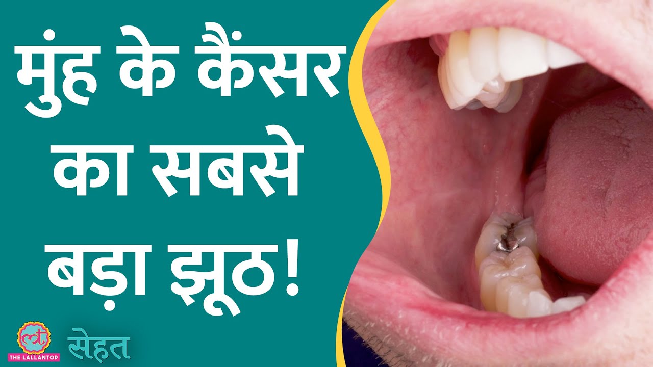 Oral Cancer यानी मुंह का कैंसर सिर्फ़ तंबाकू खाने वालों को होता है? | Sehat ep 561