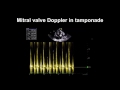 Echocardiography Essentials: Detecting pericardial effusions