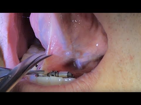Lingual Frenuloplasty for posterior tongue tie: How we do it.