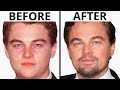 Has Leonardo DiCaprio Had Plastic Surgery? | Plastic Surgery Analysis