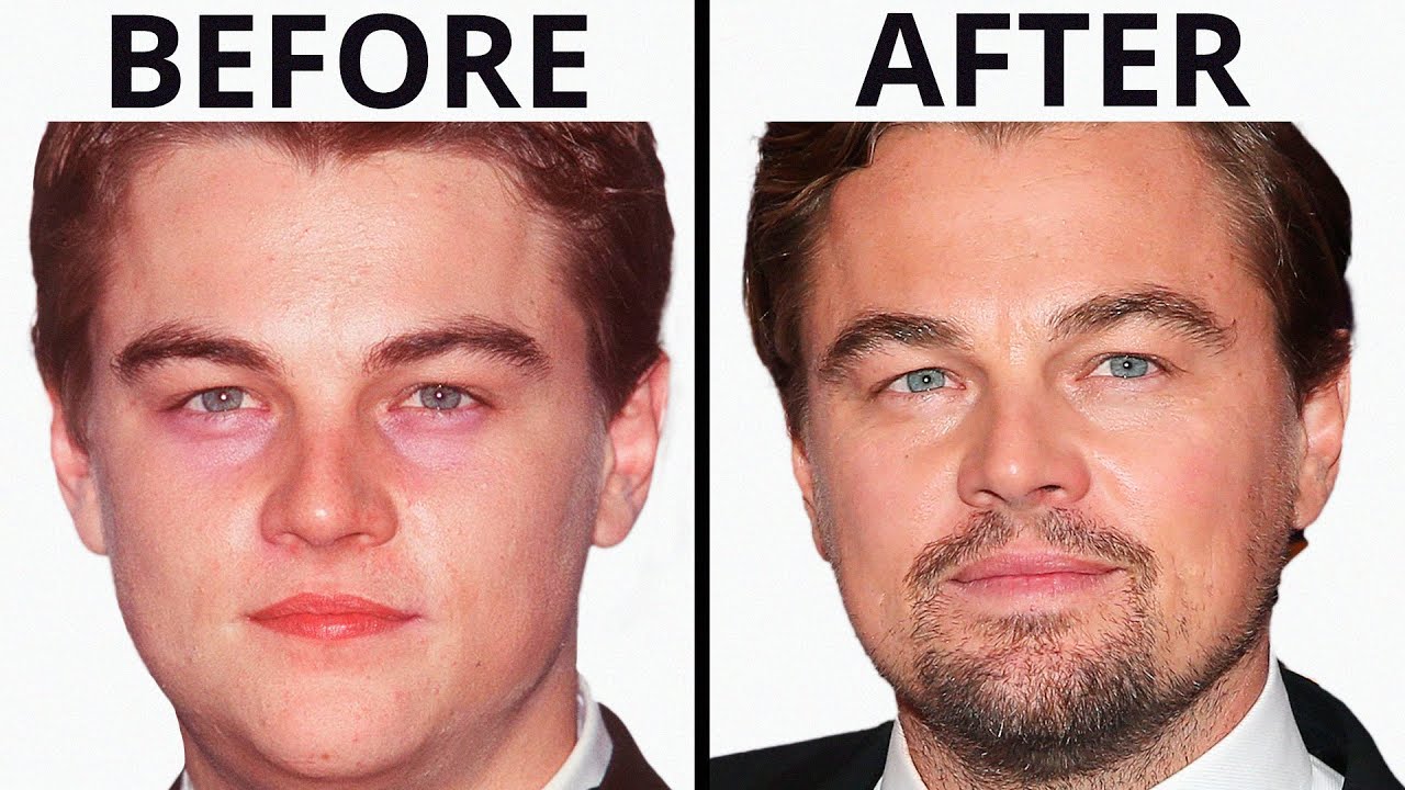 Has Leonardo DiCaprio Had Plastic Surgery? | Plastic Surgery Analysis