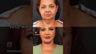 Rocio's Facelift Story