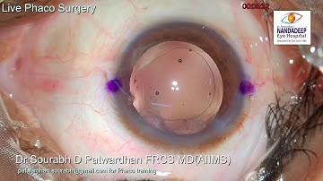 Live phaco cortex aspiration by phaco probe Dr Neto