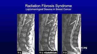 Cancers Commonly Associated with Radiation Fibrosis Syndrome | Memorial Sloan Kettering