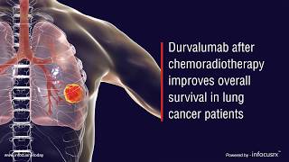 Durvalumab after chemoradiotherapy improves overall survival in lung cancer patients