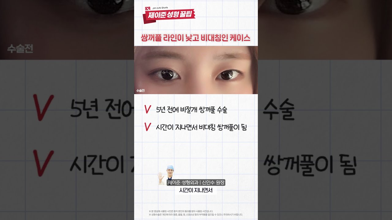 [Phẫu thuật thẩm mỹ và Da liễu JAYJUN] Tôi đã phẫu thuật lại vì mí mắt bị thấp và không đối xứng #shorts [Mẹo hay của JAYJUN]