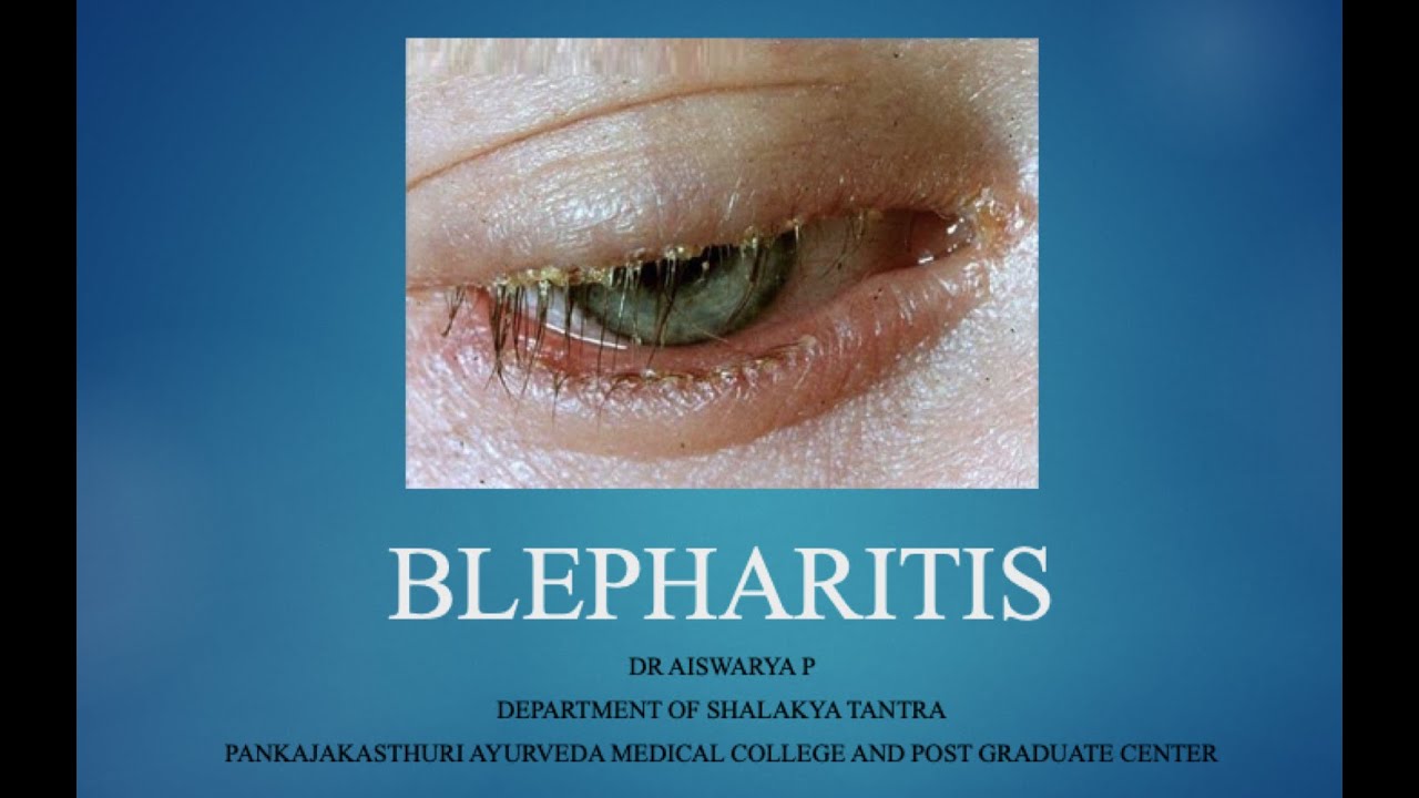 BLEPHARITIS 