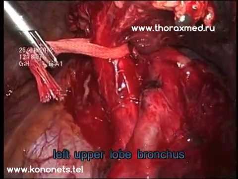 Totally Thoracoscopic Left Upper Lobectomy for I stage NSCLC