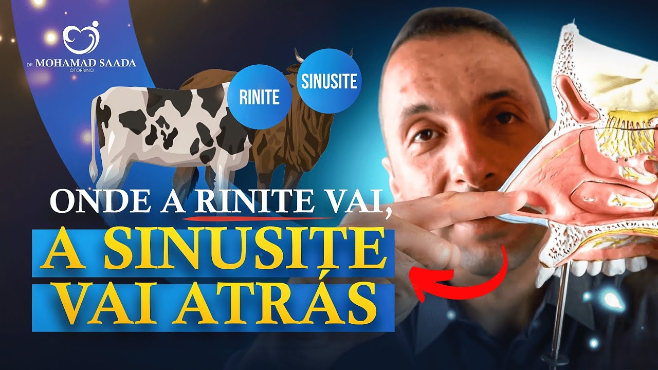 ONDE A RINITE VAI A SINUSITE VAI ATRÁS