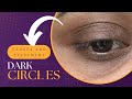 DARK CIRCLES | TREATMENT | CAUSES | PRECAUTION | DULL EYE | DRY EYE | REMEDY | CREAMS & SERUM