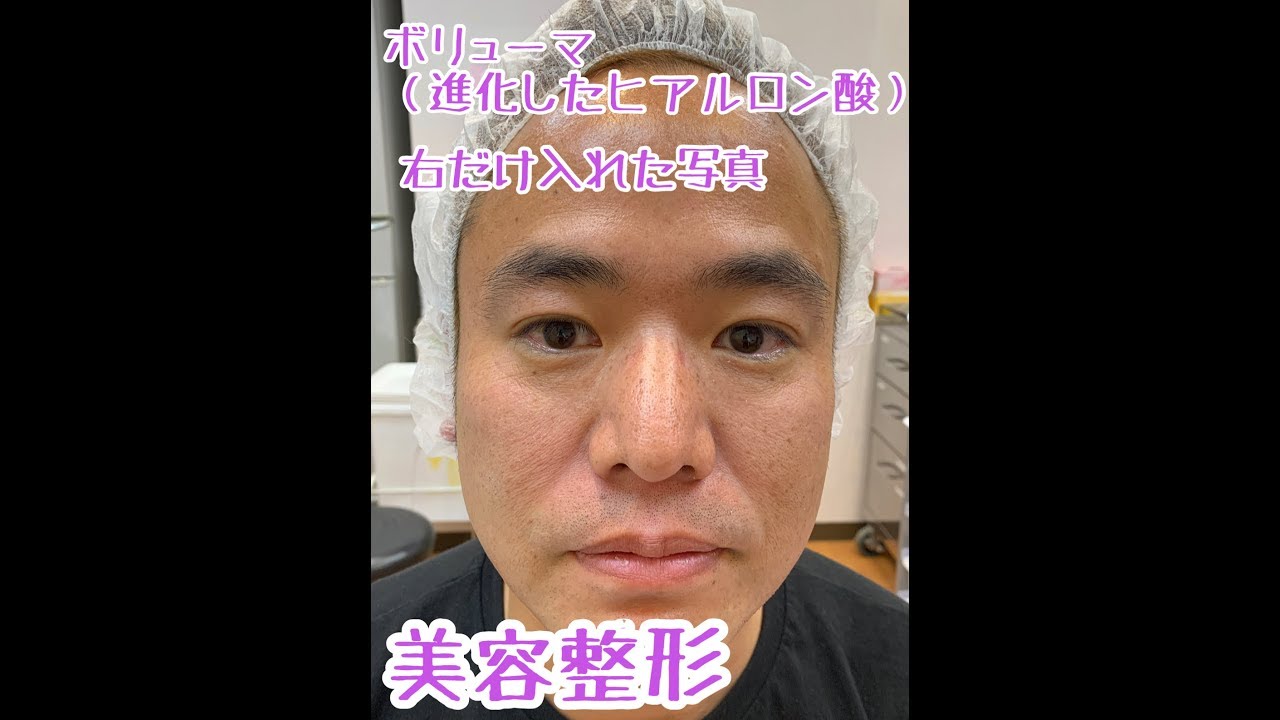 40代の男性が ほうれい線を消すためにボリューマ 進化したヒアルロン酸 を注入してきた Youtube