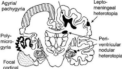 Neuronal Migration Disorders