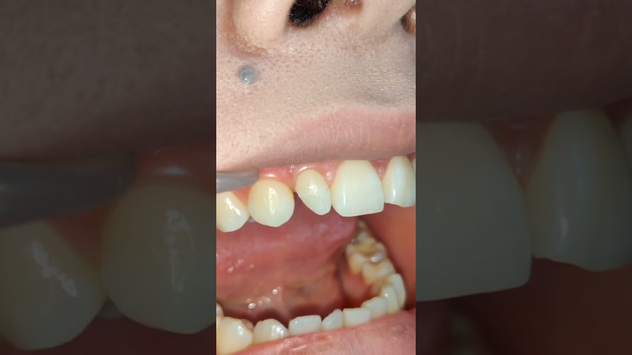 Реставрация или винир? #стоматологалматы #брекетыалматы