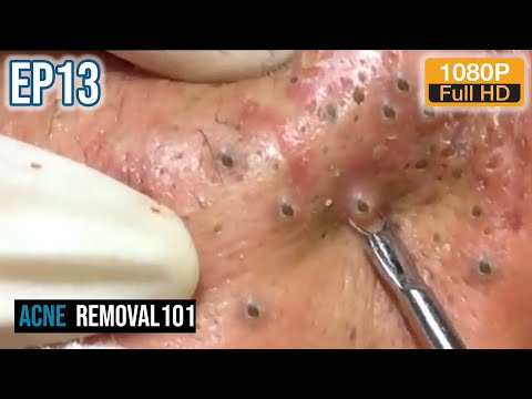 Cystic Acne Extraction 32mn , Blackheads Removal by ACNEREMOVAL101