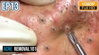 Cystic Acne Extraction 32mn , Blackheads Removal by ACNEREMOVAL101 screenshot 2