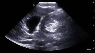 Invaginación Intestinal en Lactante de 8 meses - Hallazgos por Ultrasonido