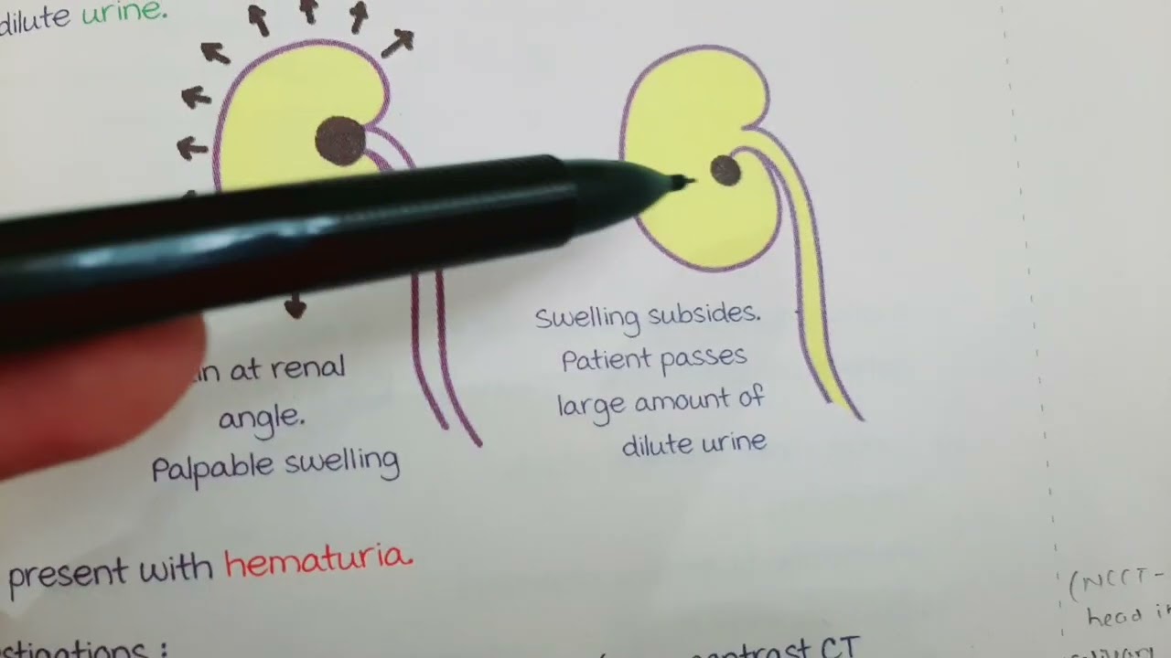 Kidney Stones - Types Calcium Phosphate Stones , Clinical features, Investigations, Management MBBS