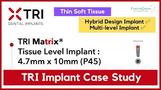 Tri Matrix Implant Case Study 4.7Mm X 10Mm Thin Soft Tissue - Updated Version
