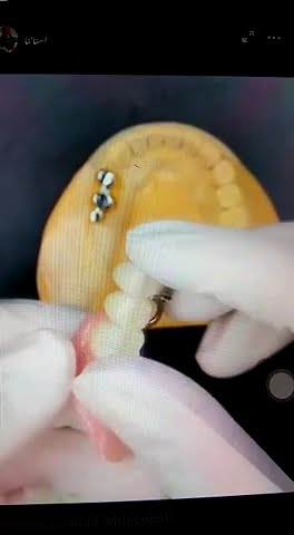 Removable Rpd with fix teeth - YouTube