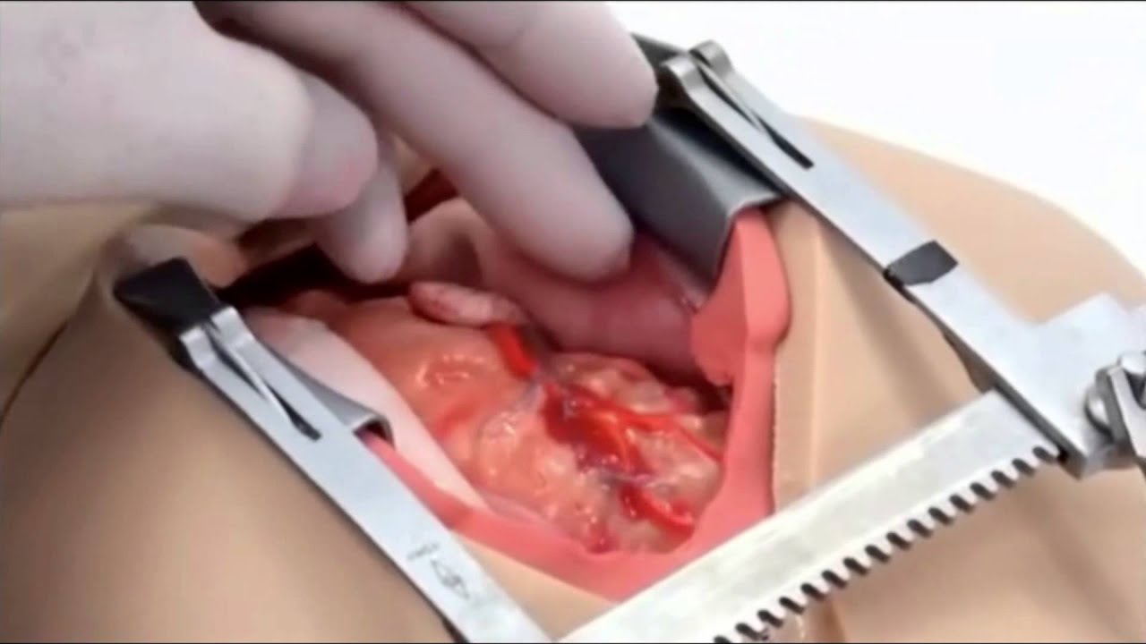 Surgical Sam From The Chamberlain Group | IMSH 2015 Interview