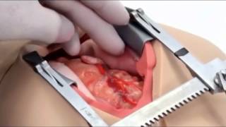 Surgical Sam From The Chamberlain Group | IMSH 2015 Interview