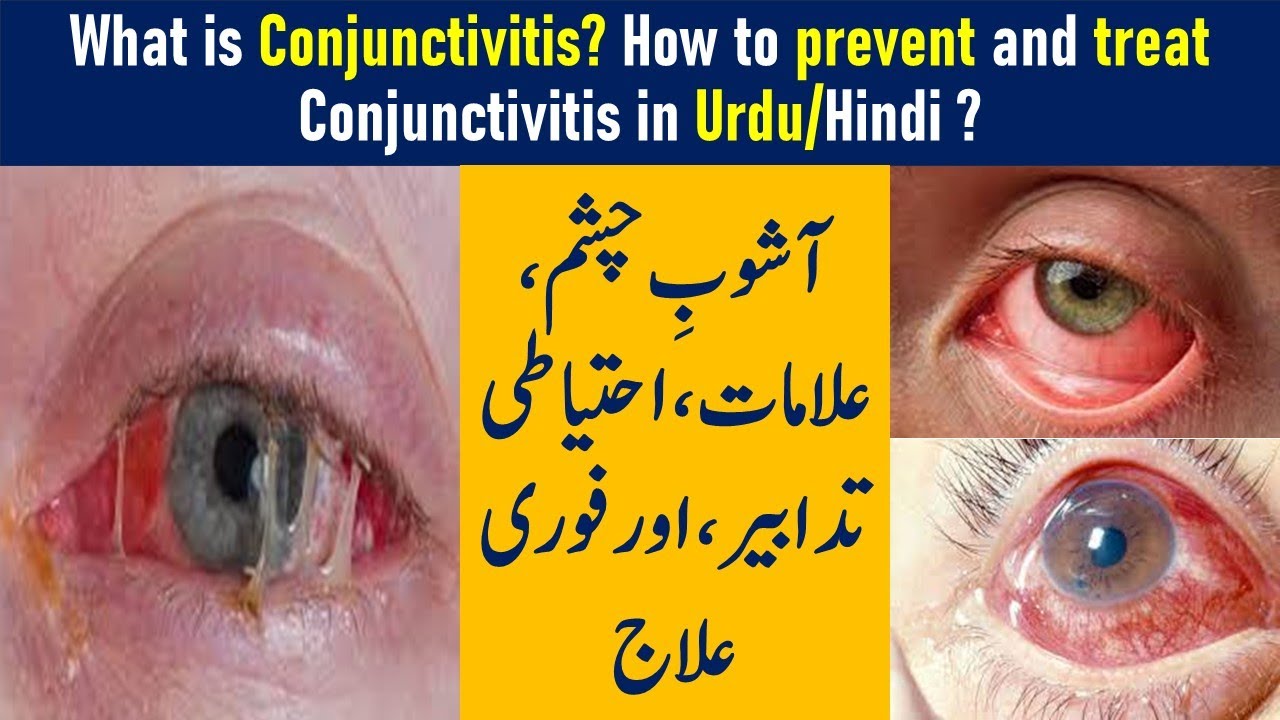 Ashob-e-Chasm Ka ilaj/Pink Eye infection|Conjunctivitis,Symptoms,Prevention and Treatment In Urdu 