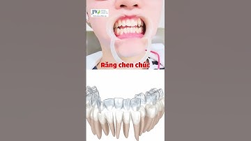 ẢO DIỆU biết trước kết quả NIỀNG RĂNG TRONG SUỐT AI thần tốc với công nghệ AI ITERO 5D