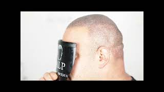 Scalp pigmentering