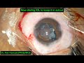 A Challenging case of Captured IOL with PCO