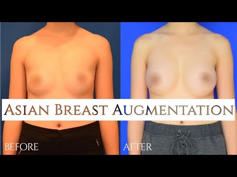 Asian Breast Augmentation with Before and After - Barrett Plastic Surgery Beverly Hills