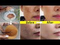 In 3 usesremove pigmentation dark spots acne marks melasma     get bright spotless skin