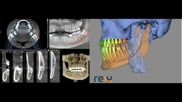 Nerve tracing - Comparison between manual and AI Nerve tracing