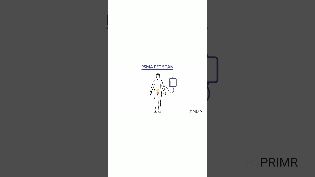 Can PSMA PET scans + traditional tests improve cancer detection?